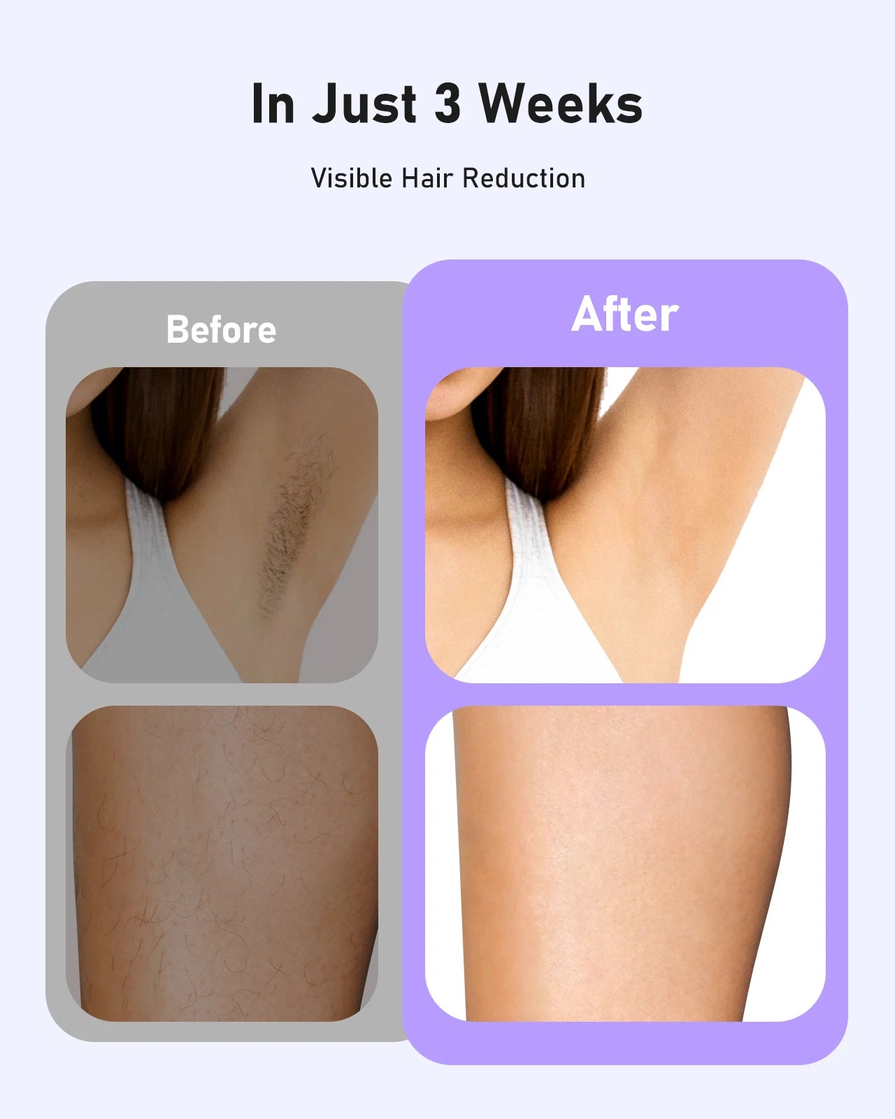 IPL Laser Hair Removal Device – 9 Energy Levels Permanent Hair Remover